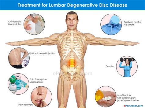 Treatment Degenerative Disc Disease Lumbar at Jasmine Thornber blog