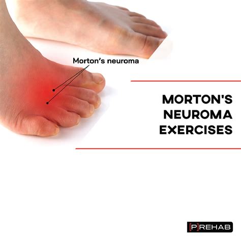 Morton’s Neuroma Exercises – INSTAGRAM Toe Exercises, Foot Stretches ...