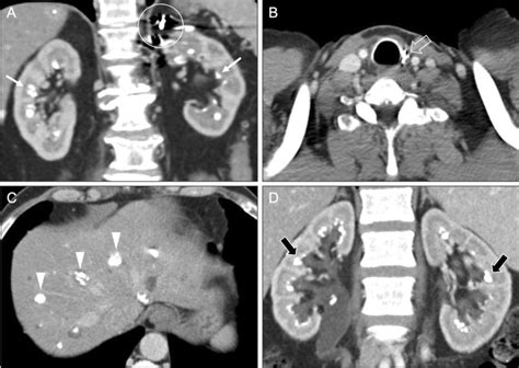 Other Causes Of Medullary Nephrocalcinosis Coronal A And Axial B