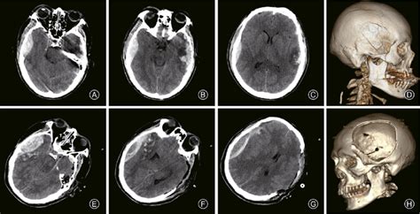 A 55 Year Old Man With Progressive Epidural Hematoma Following Traffic