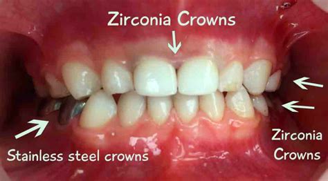 Ceramic Dental Crowns Type Cost And Advantage