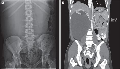 Massive Retroperitoneal Cystic Mass In An Adolescent Adolescent