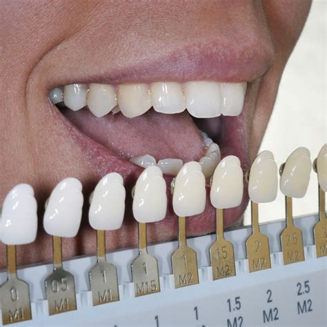 Veneers Merritt Island, FL - Porcelain Veneers - Chan Wilkhu, DMD, PA