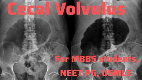 Cecal Volvulus And Bascule For MBBS Students Neet PG Usmle I Neet