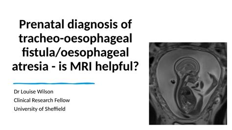 Pdf Prenatal Diagnosis Of Tracheo Oesophageal Fistula Oesophageal