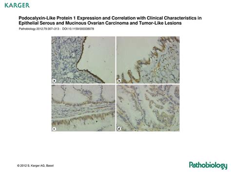 Podocalyxin Like Protein Expression And Correlation With Clinical