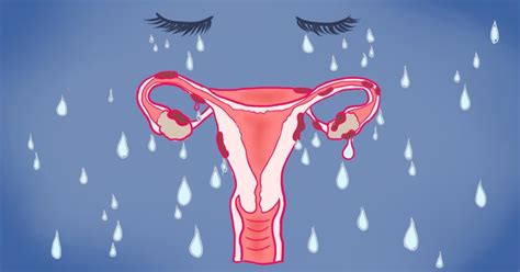 Признаки эндометриоза