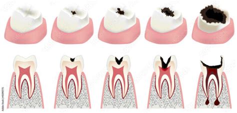 Dental Abscess And Facial Swelling Understanding The Connection My