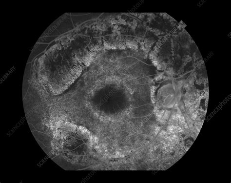 Rod Cone Dystrophy - Stock Image - C027/2243 - Science Photo Library