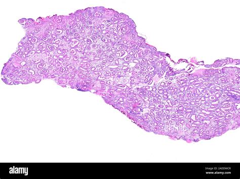 Endometrial Hyperplasia Light Micrograph Complex Endometrial