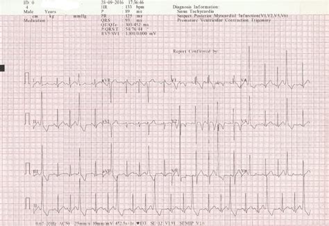 An ECG showing sinus rhythm with ventricular trigeminy, normal axis ...