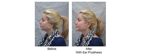 Auricular (Ear) Prosthesis for Osseointegrated Ear Implant | Custom ...