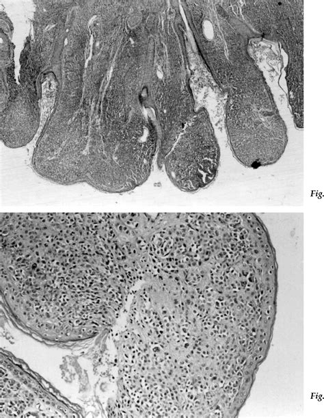 Intradermal Nevus Of The External Auditory Canal A Case Report