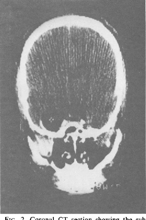 Figure 1 From Preoperative Diagnosis Of A Ruptured Intracranial Dermoid