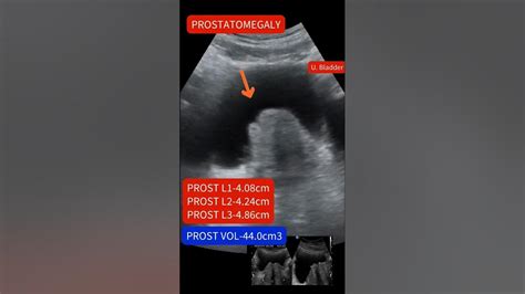 Ultrasound Showing Enlarged Prostate Prostatomegaly Ultrasound Youtube