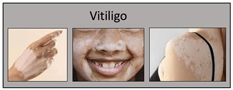 Como Começa O Vitiligo Na Pele - Vitiligo - Medicina de Excelência