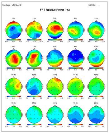 What Is A Qeeg Brain Map Artofit