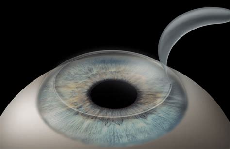 Laser Eye Surgery Recovery Tips : One Thing - HopingFor Blog