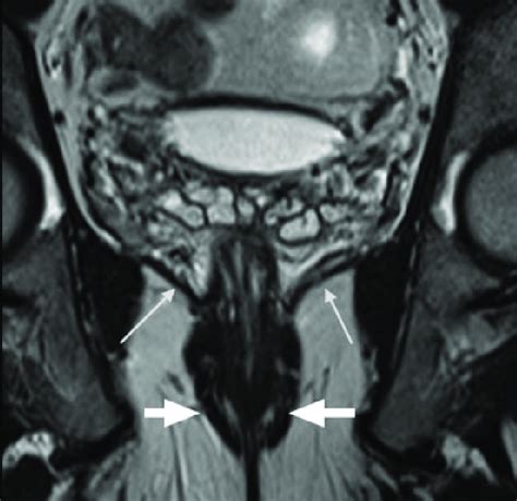 Normal pelvic floor anatomy: T2-weighted coronal image of the pelvis ...