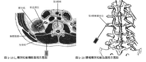 针刀篇第3腰椎横突综合征