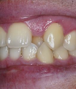 Procedimientos Combinados Caso Cosm Tica Dental Burga