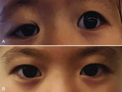 Female child with ptosis of the right eye before treatment (A) and 11 ...