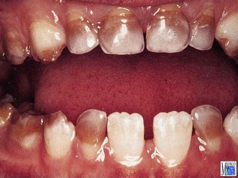 Enamel hypoplasia ppt