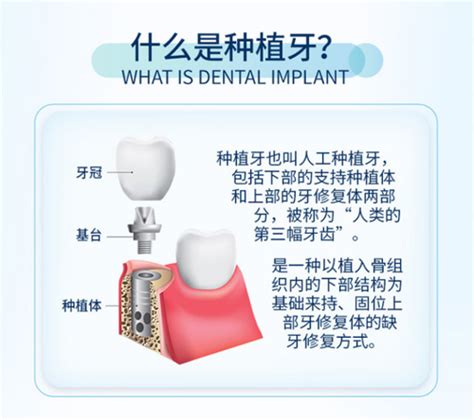 种植牙多少钱一颗2023价格表更新，2023种植牙收费价目表公布！ 医秀网