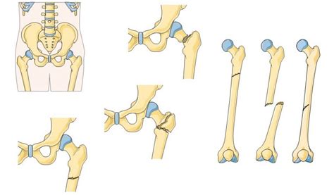 Fractura De F Mur Causas Y Tratamiento Camde M Laga