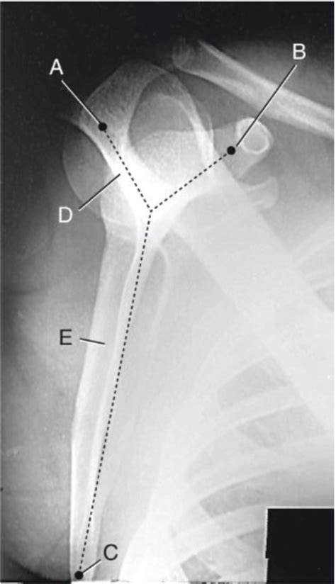 Scapula Anatomy On Xray Lateraly View Diagram Quizlet