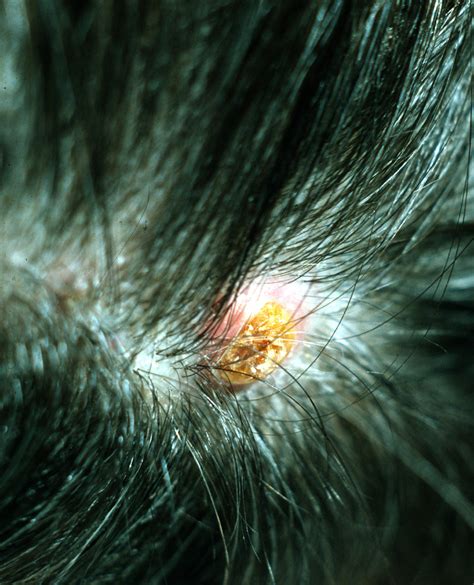 Proliferating Trichilemmal Tumor Proliferating Tricholemmal Tumor