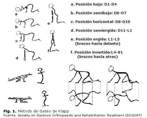 Enfoque Actual En La Rehabilitación De La Escoliosis