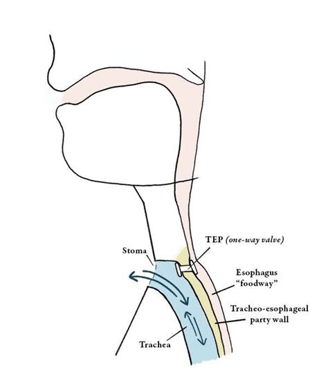 Tracheoesophageal Voice Prosthesis Tep Dr Robert Bastian