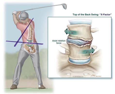 Barrow Spine Surgeons Discuss Back Problems In Golfers Barrow