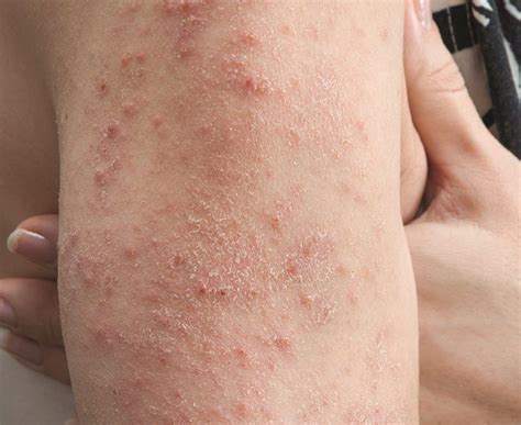 Which Of The Following Diseases Causes A Skin Rash Resolve Abouthairloss