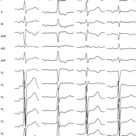 Representative examples of the P-waves morphology during para-Hisian ...