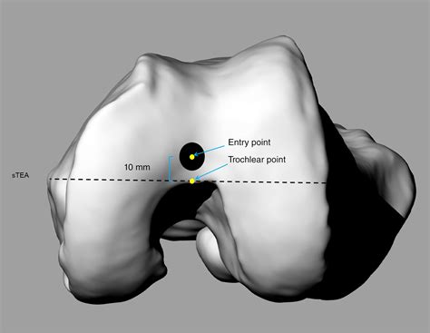 Optimal Sagittal Insertion Depth And Direction Of Femoral