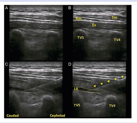 Figure From Surgery Of The Axilla With Combined Brachial Plexus And