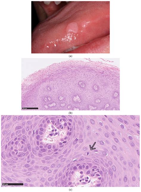 Focal Epithelial Hyperplasia