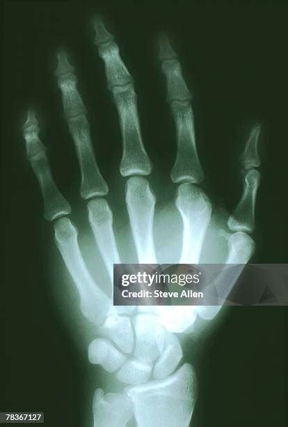 118 Broken Finger X Ray Stock Photos, High-Res Pictures, and Images - Getty Images