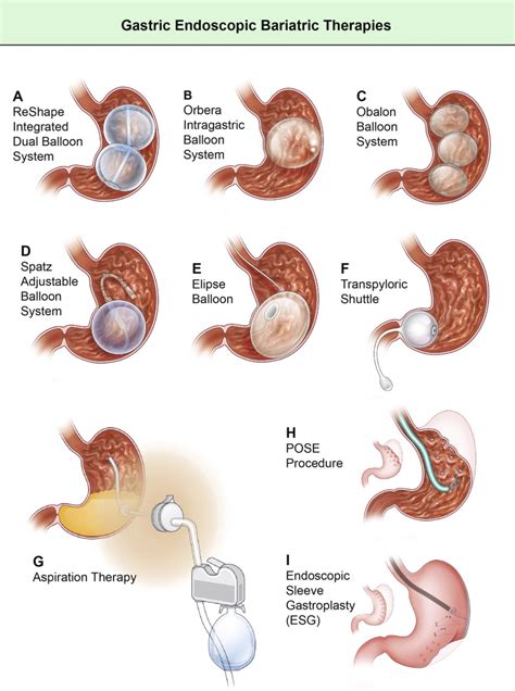 Endoscopic Bariatric And Metabolic Therapies New And Emerging