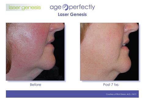 Laser Genesis | Age Perfectly