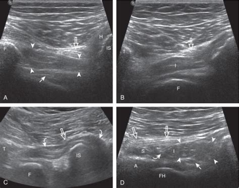 Diagnostic Ultrasound Of The Hip Sports Medicine Review