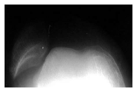 Skyline view radiographs show patella location (a) before and (b) after ...