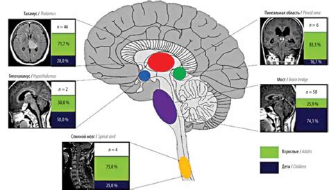 Distribution Of H3 K27m Mutant Diffuse Midline Glioma In Adult And