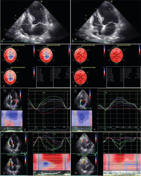 Echocardiograms Two Dimensional Echocardiograms Show Diffuse