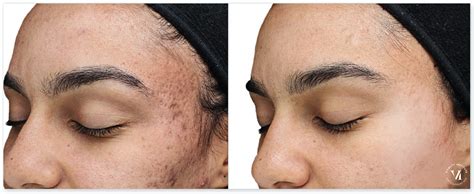 Vi Peel Purify With Precision Plus Renew Dermatology Birmingham Al