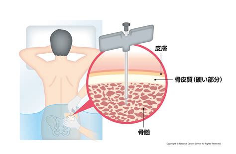 多発性骨髄腫の検査・診断について｜国立がん研究センター