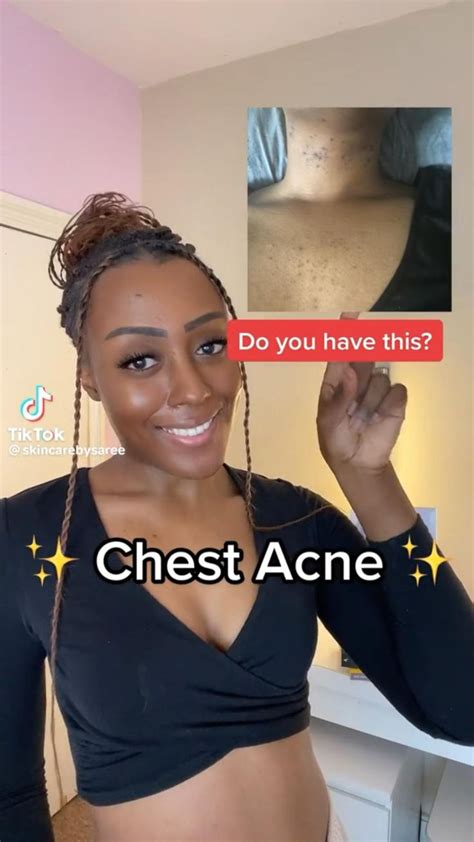 Tips For Chest Acne In 2024 Chest Acne Chest Acne Treatment Serious Skin Care