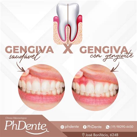 Gengiva Saudável X Gengivite - PhDente - Consegue diferenciar uma gengiva saudável e uma gengiva com ...